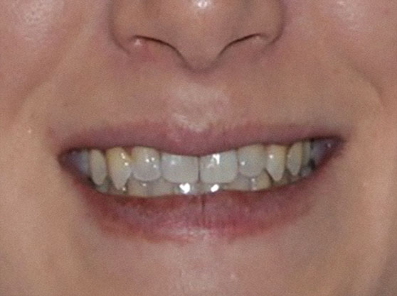 Before teeth whitening