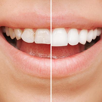 Before & after smile design gallery